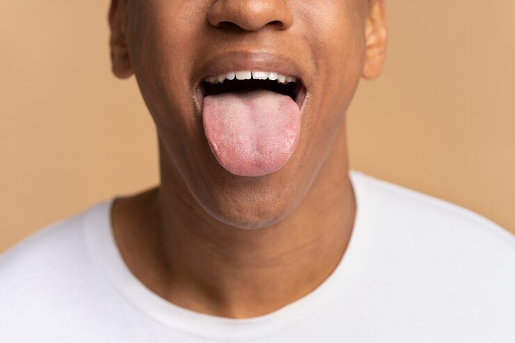 Dilin ağ olması hansı xəstəliyin əlamətidir?